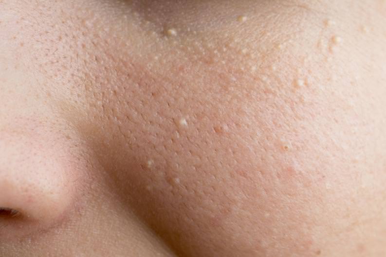 White spots on skin: what they are, why they appear and how to eliminate them
